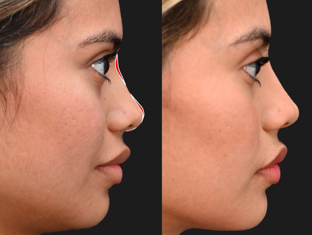 Ja Nonsurgical Rhinoplasty Filler Placement