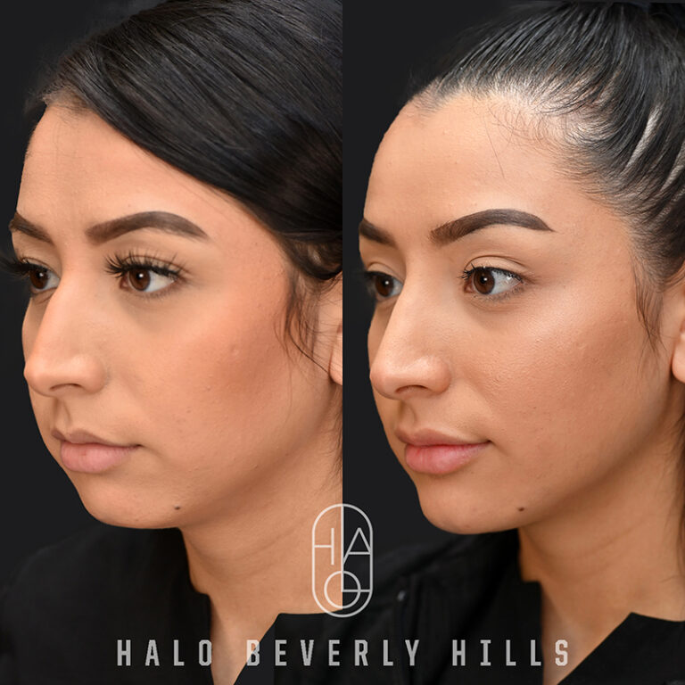 chin augmentation before and after