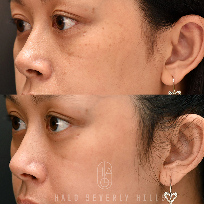 picosure before and after