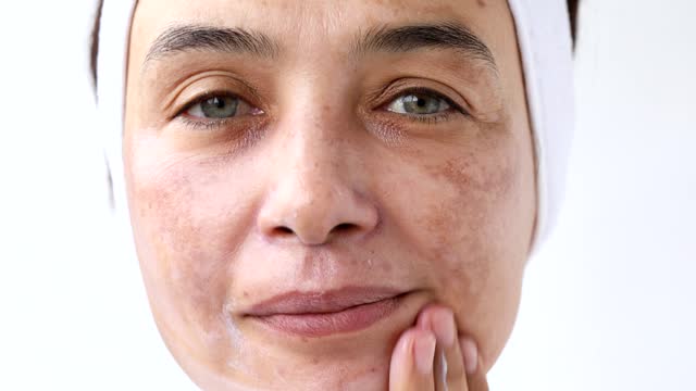 Melasma