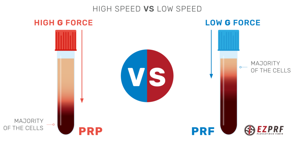 Prp Vs Prf