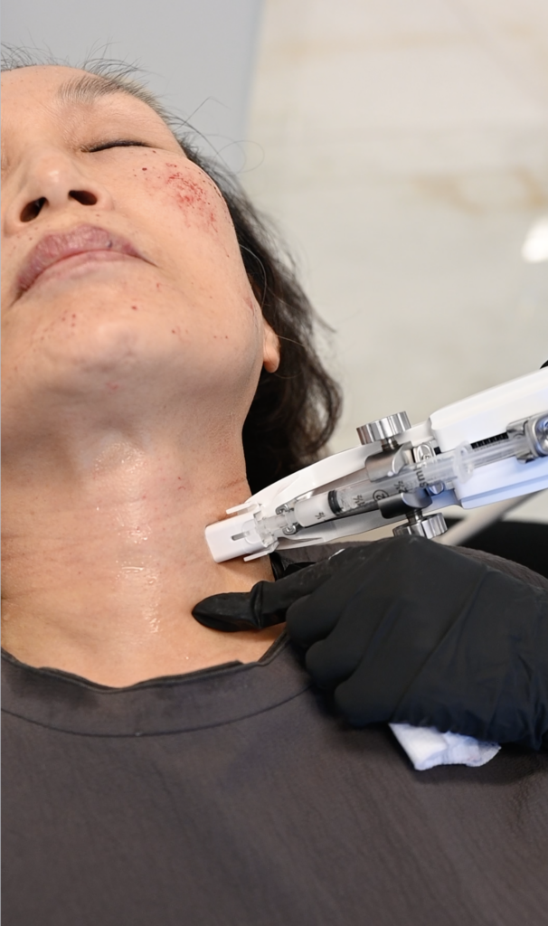 Mesotherapy on the face and neck with Juvelook 